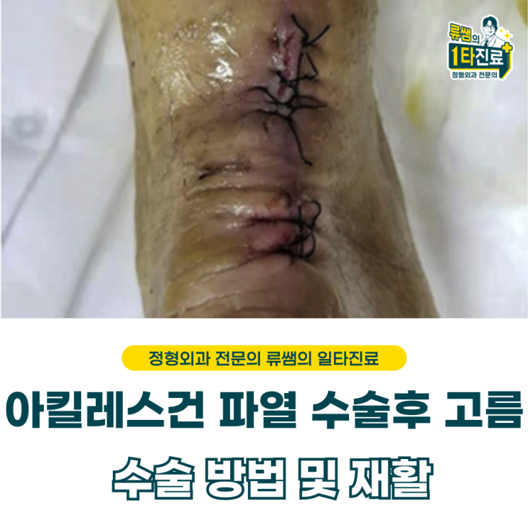  아킬레스건 수술 후 염증(고름)으로 인해서 재수술   (의사작성)