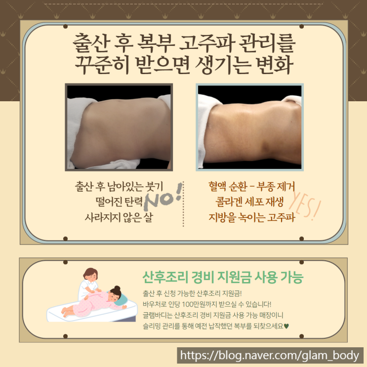  산후부종 완화, 고주파 관리로 회복하는 법