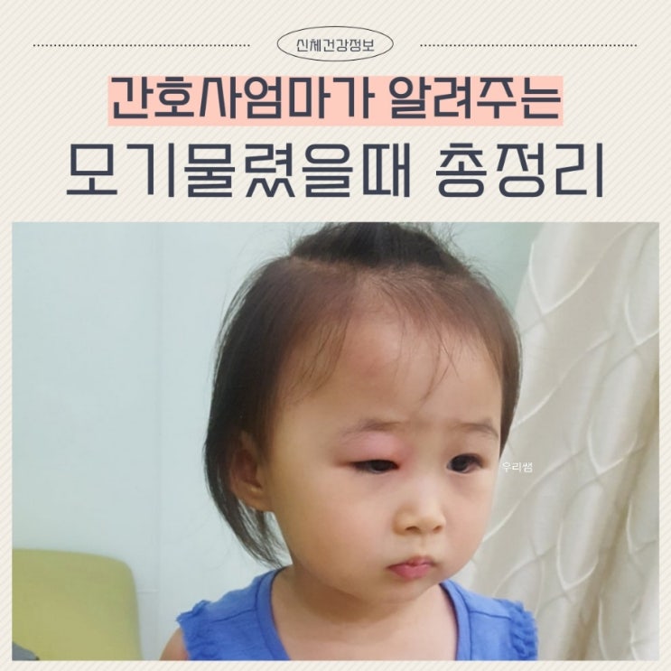  아기 모기물렸을때 가려움 연고 약 총정리