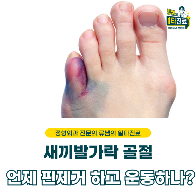  새끼발가락 골절 이후 수술 치료, 핀 제거 시기는  (의사작성)