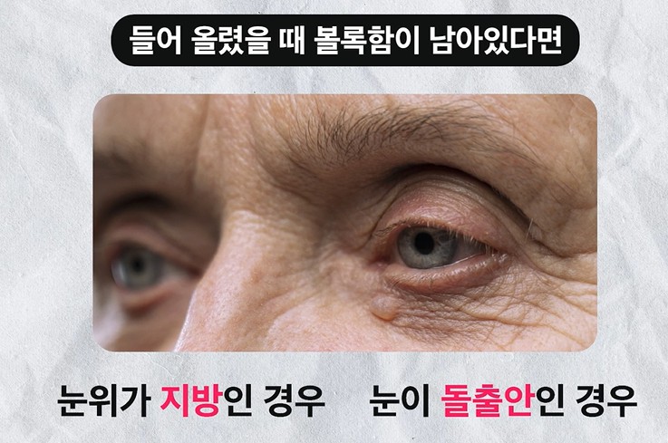 눈처짐수술을 하기 전 체크해야되는 부분부터 눈꺼풀처짐 효과까지