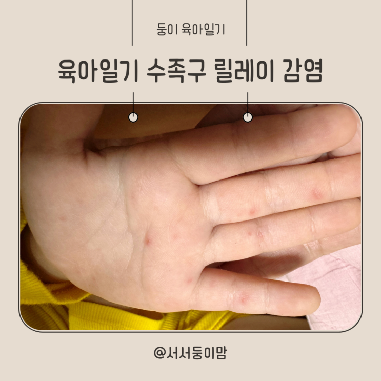  육아일기 6세 둥이 수족구 릴레이 감염 지독한 구내염