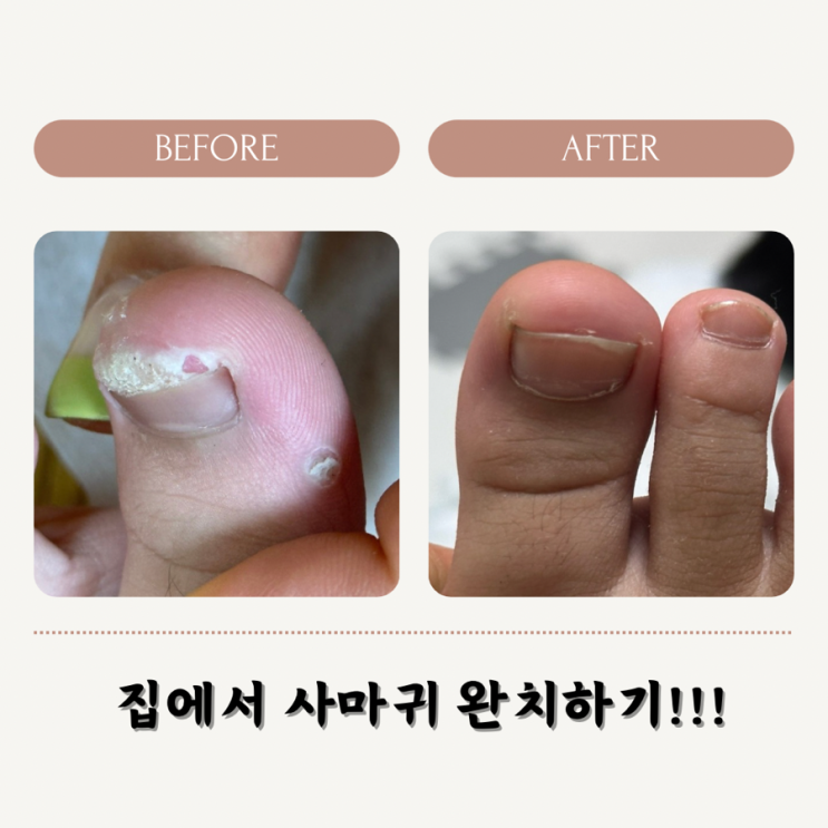  발바닥 족저 사마귀 통증없이 치료하기 !! 완치 3탄 ! 냉동치료x 주사치료x