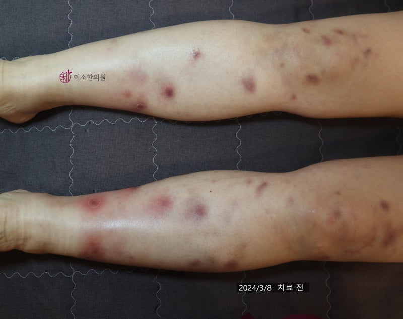 피부몽우리, 결절홍반, 종기가 아닙니다. ft, 혈관염 자가면역질환