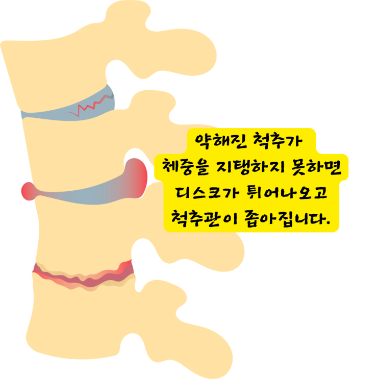  대연동한의원, 허리협착증 주사도 시술도 소용없어 좌절하시는 분들께 드리는 편지