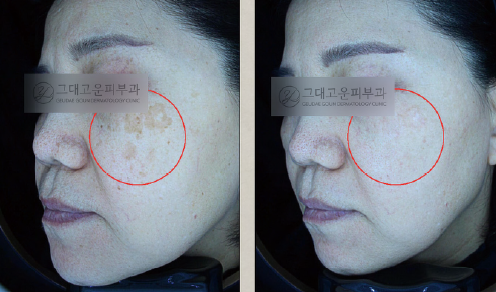 센텀 피부과추천? 저라면 이런 곳에 갑니다. 센텀 피부과추천? 저라면 이런 곳에 갑니다.