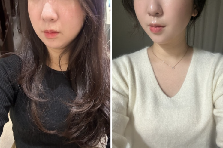  강남역피부과 인모드 튠페이스 효과 강추 후기