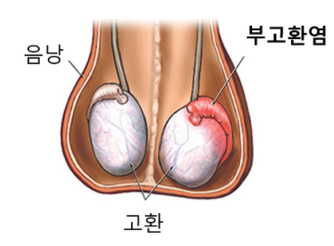 만성 고환 통증, 만성 부고환염