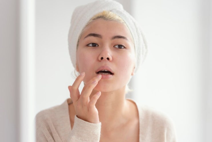 입술 헤르페스 원인 증상 및 구순포진 입술포진 치료(간지러음)