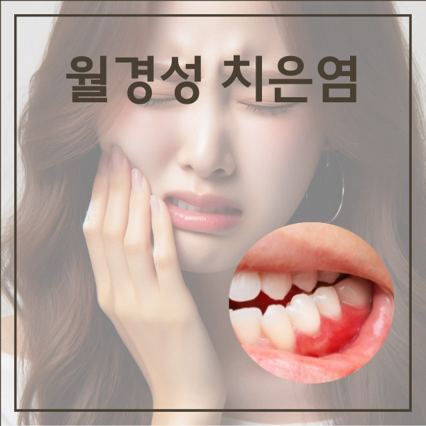 여성호르몬 변화에 따른 월경성 치은염 관리 어떻게 할까?