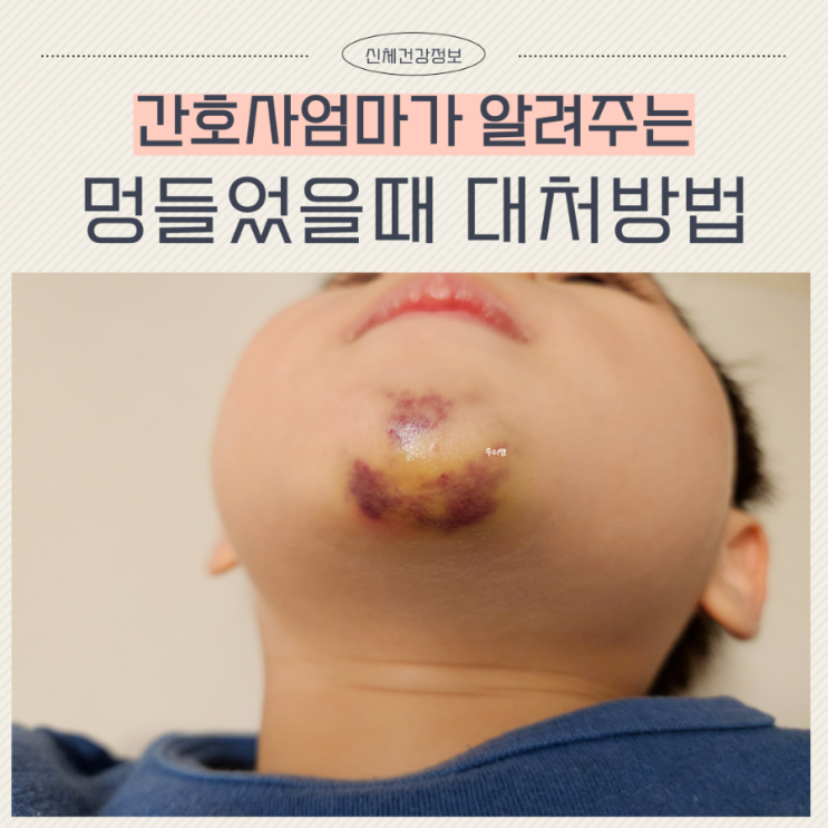  아기 얼굴 멍 연고 멍들었을때 대처방법
