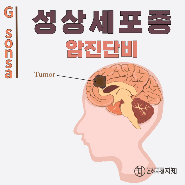  성상세포종 D43/C71, 등급에 따라 고액암 진단비 받을 수 있습니다 - 〔아빠의 질병, 1부〕