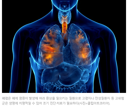 감기처럼 생각하면 큰일! 폐렴의 위험성과 예방 방법 감기처럼 생각하면 큰일! 폐렴의 위험성과 예방 방법