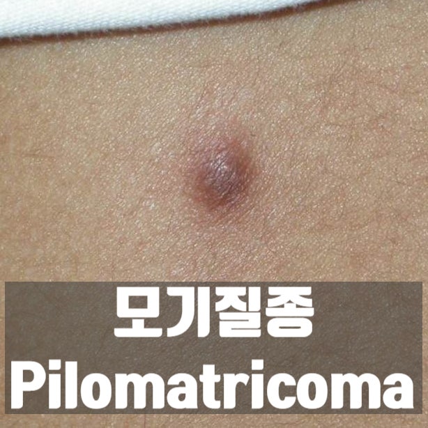  피부에 검푸르고 단단한 덩어리가? 모기질종(Pilomatricoma)
