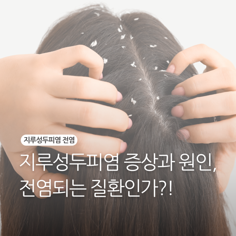 지루성두피염전염, 증상과 원인 알아보기