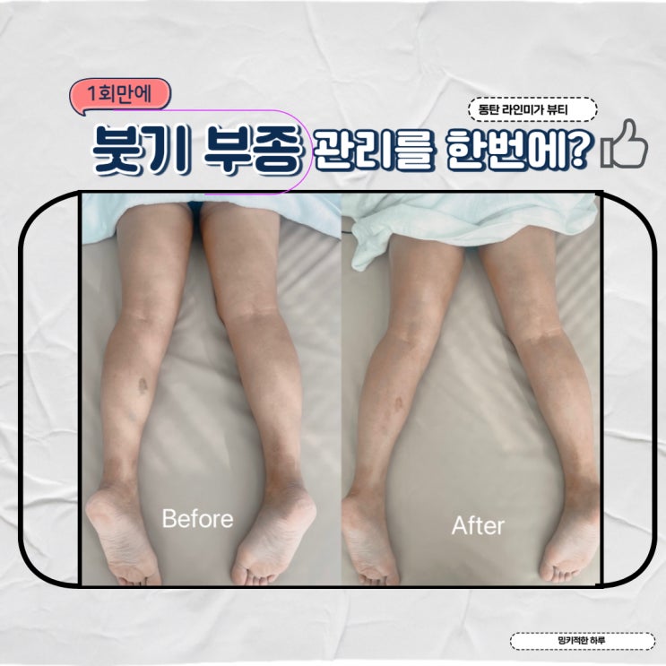  수원 인계동 붓기 부종 셀룰라이트 후관리하는법