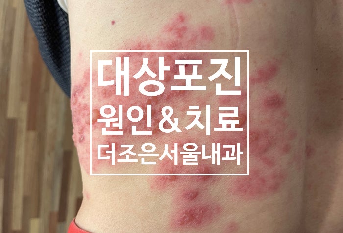  안산 대상포진 수포치료 통증관리 잘하는 병원