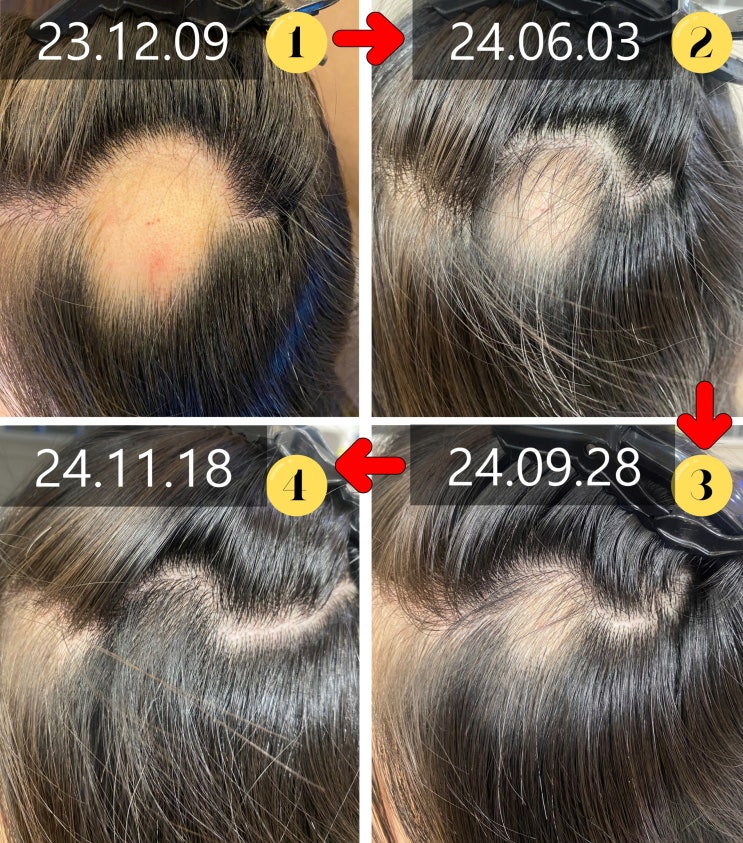  '부분 원형탈모'인데도 치료기간 길어지는 이유. 원래대로 회복하는 방법은?