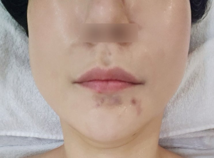  분당 여드름 환절기 피부 관리 유하 에스테틱 베르도소 진정관리 후기