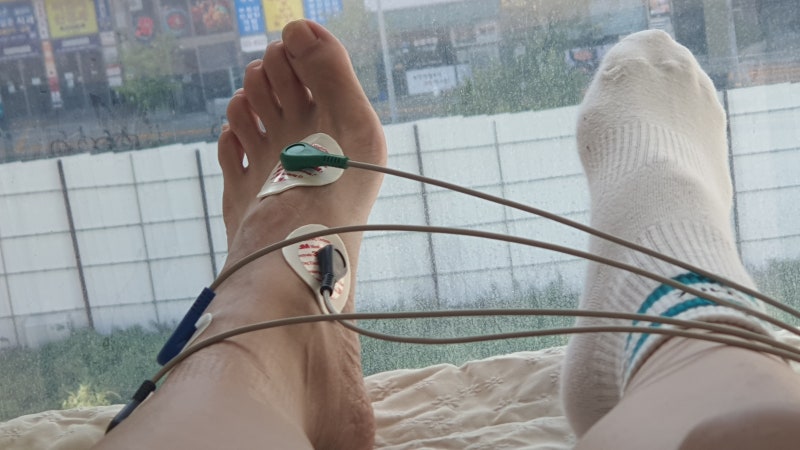 발등이 안굽혀지고 신발이 벗겨지는 족하수(풋드랍) 치료 및 후기
