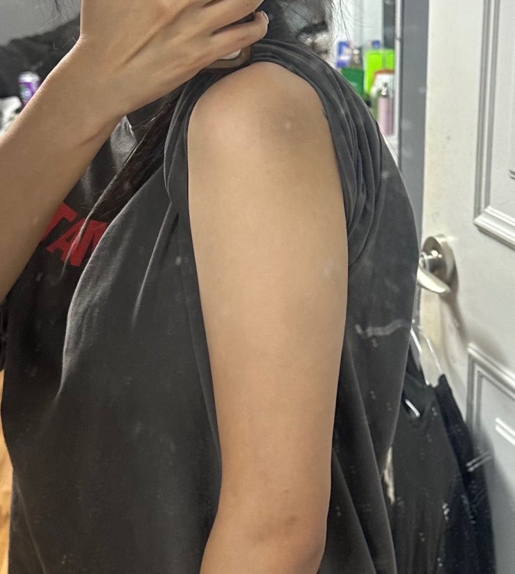  청담 피부과 팔뚝지방분해주사 후기 (통증, 멍, 효과, 가격) 압구정 피부과