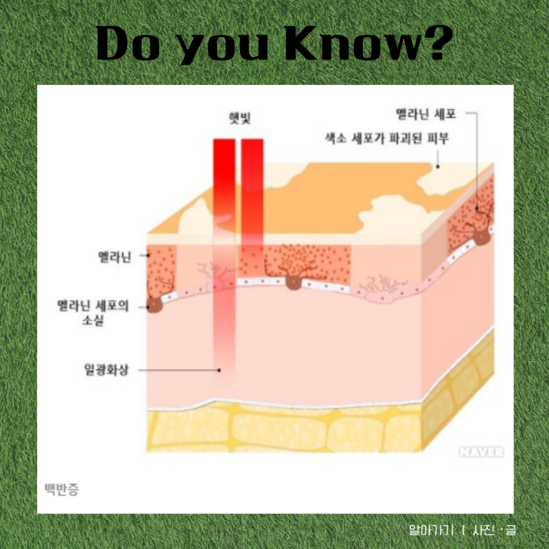 백반증 치료 비용 및 모든 것 알아가기