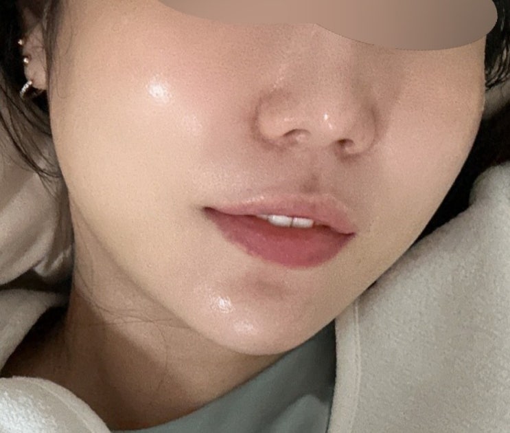  처진 볼살 리프팅 신사역 피부과 튠페이스 다이아튠 후기 + 부작용, 붓기, 가격/비용