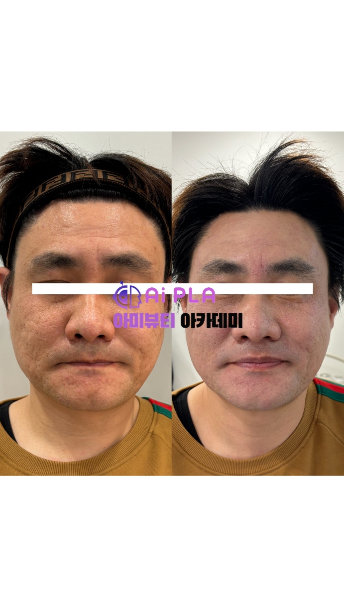  [대구피부관리]40대, 젊음을 되찾다: 팔자주름과 이마주름을 아미뷰티 플라즈마 써마지로 개선하세요