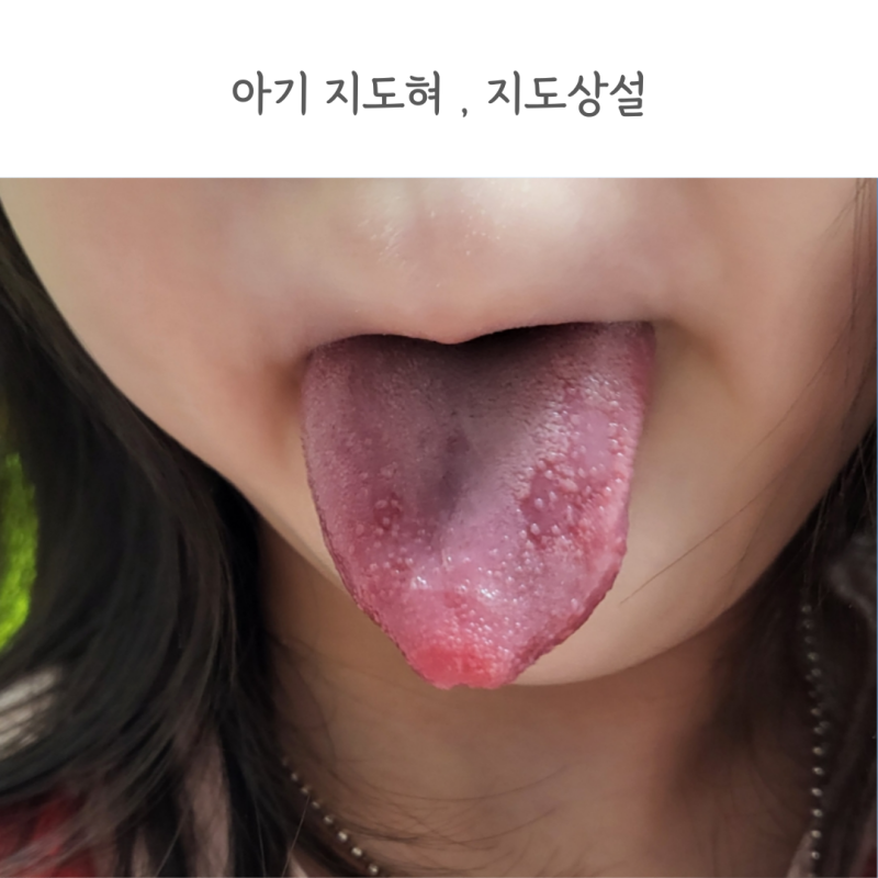 아기 지도혀 지도상설 지도설 원인 대처방법 관리방법