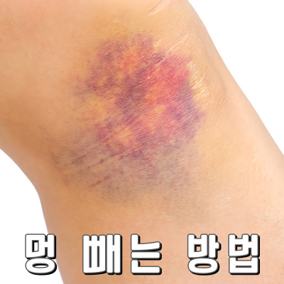 피부 멍 완화의 모든 것