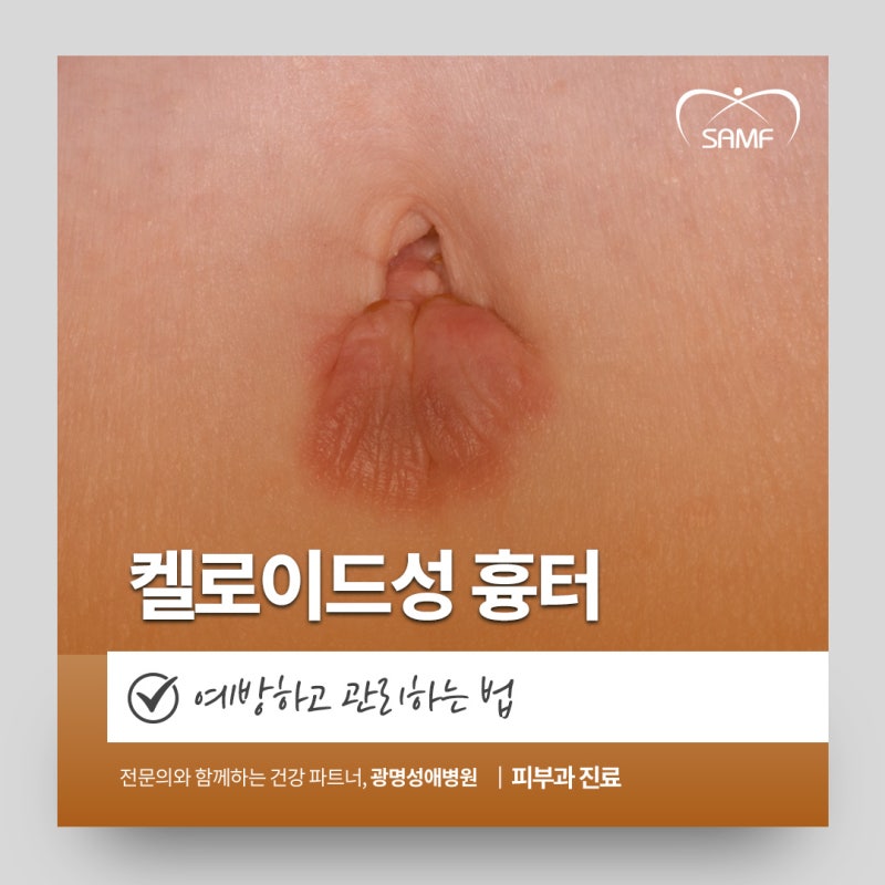 켈로이드성 흉터, 가산동피부과에서 예방하고 관리하는 법