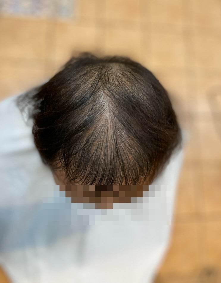  전라도해남에서 왔다구요? 전체탈모로 고통받고있는여성탈모고객님 펌할수있을까요! 부산소문난머리잘하는헤어르네시떼추천미용실/ 경남경북전남전북거제제주충남충북경기서울강원
