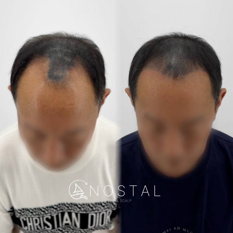  대전둔산동두피문신 잘하는 곳(+부작용 커버)