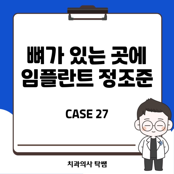  [탁쌤 CASE 27] 뼈가 있는 곳에 임플란트 정조준 feat.청주 사창동치과