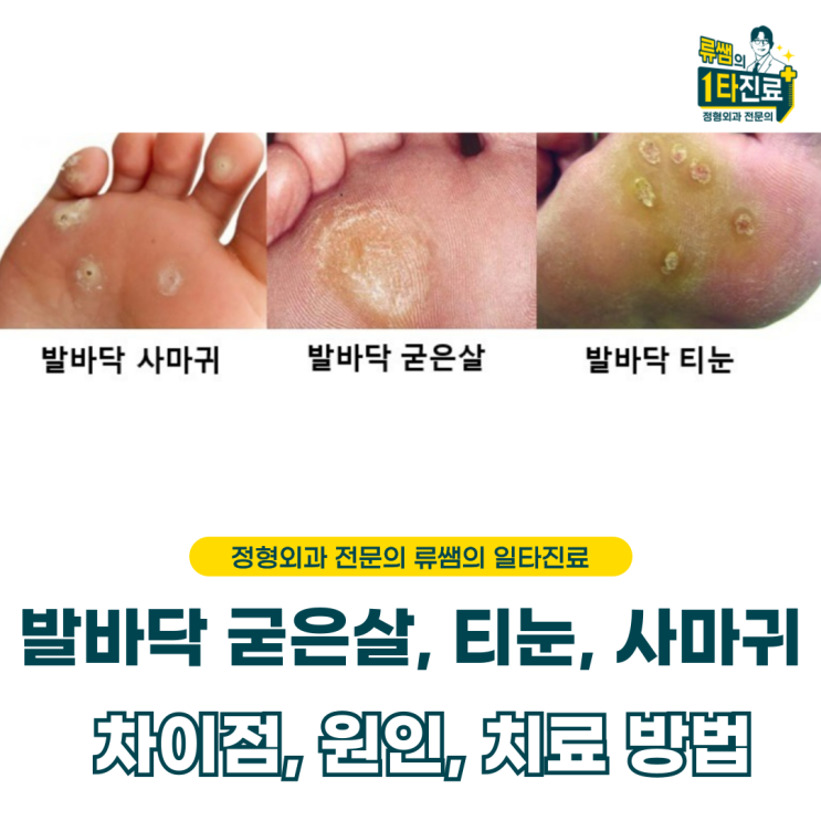  발바닥 티눈, 굳은살, 사마귀 원인 및 차이 그리고 치료법 (의사 작성)
