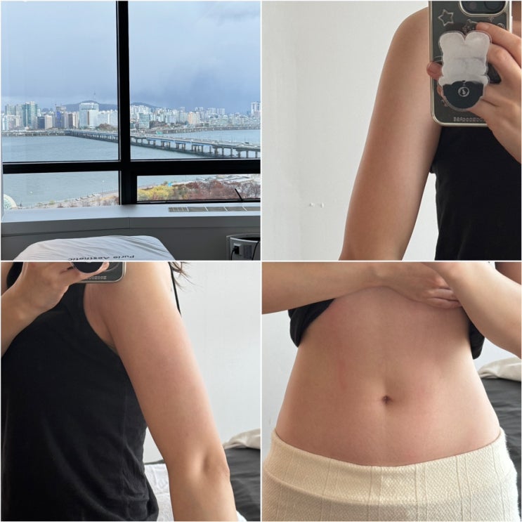  여의도에스테틱 퓨리에 더 리버뷰 상체 승모근, 팔뚝 바디관리