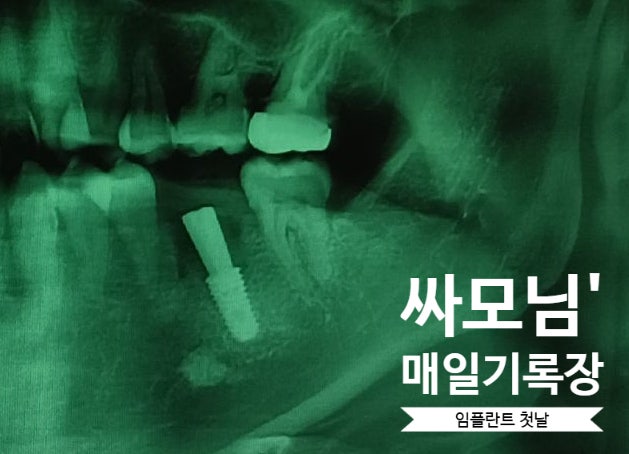 하루만에 발치와 임플란트 식립, 뼈이식 후기 [오스템임플란트, 임틀란트가격, 통증, 출혈]