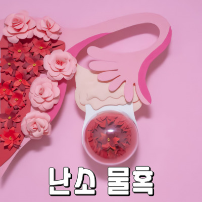 여성이라면 알아야 할 난소 물혹의 원인과 증상