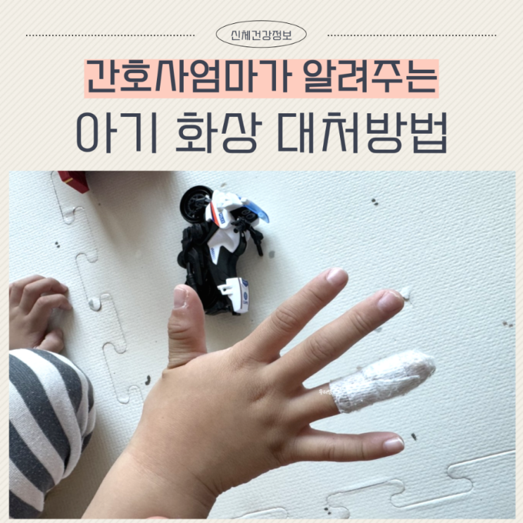  아기 화상 연고 손가락화상 비판텐연고 아즈렌연고