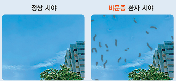 눈 앞에 날파리가 날아다니는 것 같이 보이는 비문증이 생기는 이유, 단순한 비문증과 질병 ....