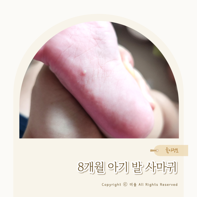 8개월 아기 사마귀 발바닥 치료 후기