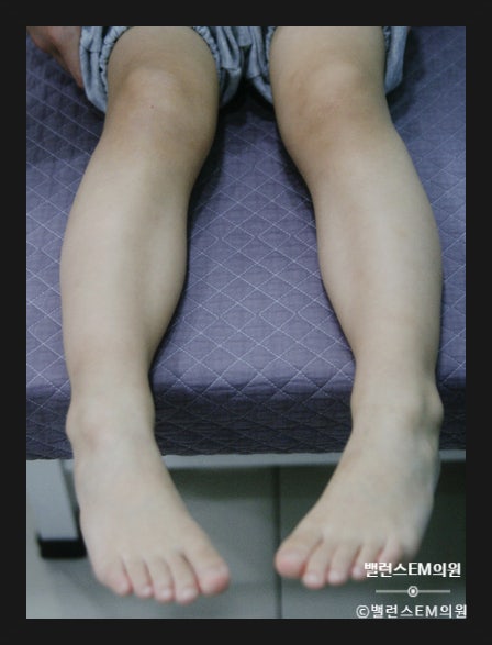  소아 안짱다리, 10살 전에 수술 없이 치료하세요.