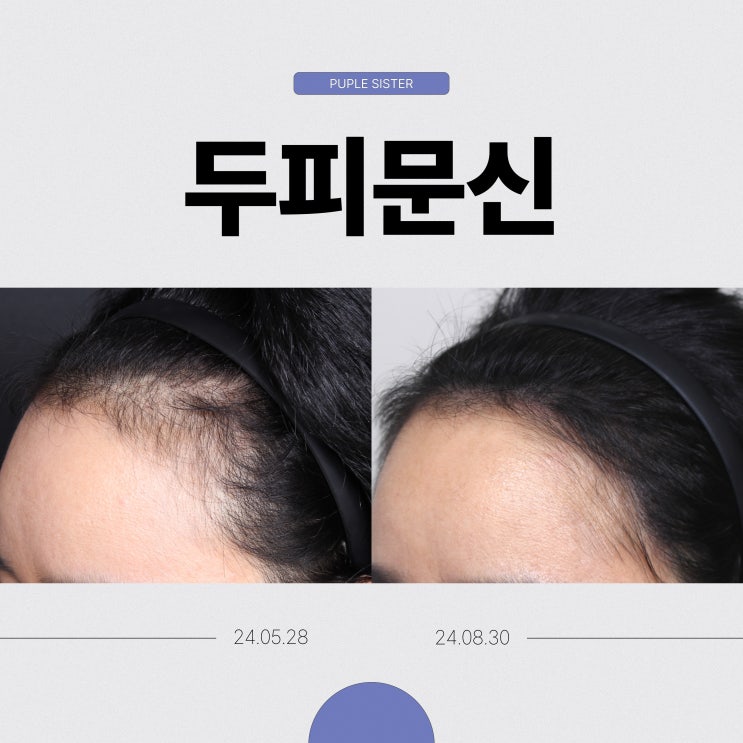  모발이식 재수술의 부담, 두피문신으로 해결하는 방법 상암동피부과추천