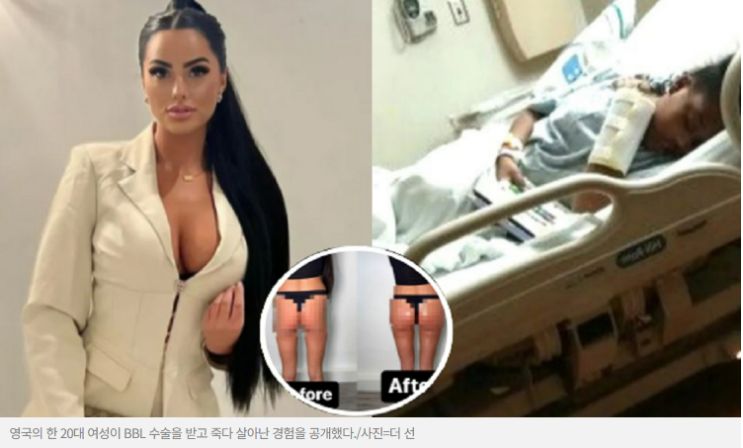 엉덩이 키우려다 죽다 살아나다..? 20대 여성이 겪은 BBL 수술의 위험성 엉덩이 키우려다 죽다 살아나다..? 20대 여성이 겪은 BBL 수술의 위험성
