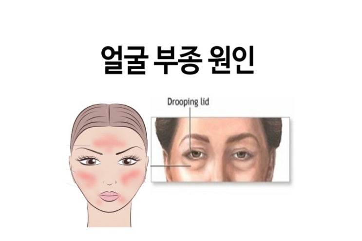  얼굴 붓기 없애는 림프 마사지 꿀팁!:선릉콩콩이네마사지샵