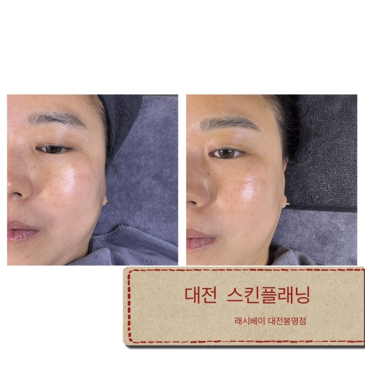  [대전] 대전스킨플래닝/봉명동피부관리 ‘래시베이‘