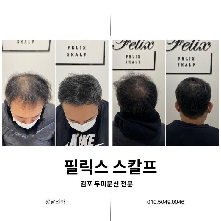  탈모약의 종류와 부작용 그 대안찿기 장기동두피문신 필릭스 스칼프