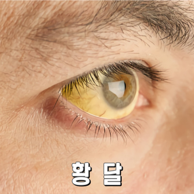 황달의 증상과 원인을 알아야 치료가 쉬워요.