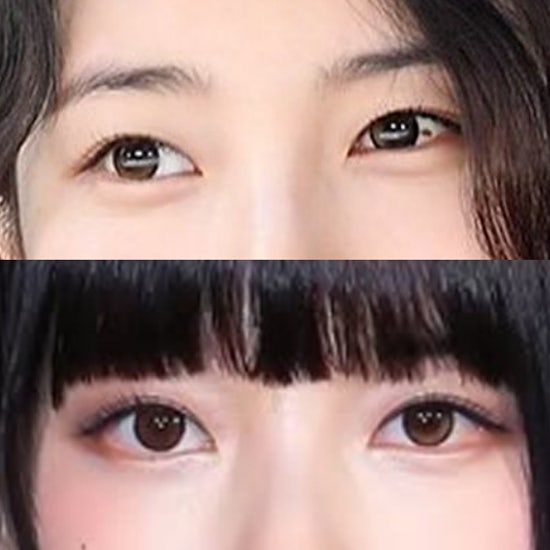 눈(안구) 점 없어진 <b>수지</b> 용안. <b>결막모반 제거</b> 방법