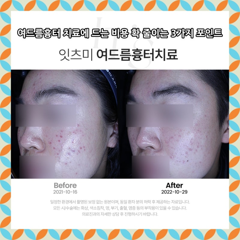 안산여드름흉터 치료에 드는 비용 확 줄이는 3가지 포인트